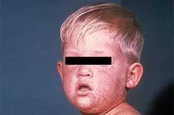 HIGHLY CONTAGIOUS: Measles is a highly contagious illness, according to NSW Health, but can be prevented by vaccination. PHOTO: NSW Health.